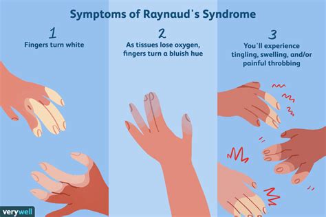 Raynaud’s Disease & Syndrome: Symptoms, Causes, Treatment